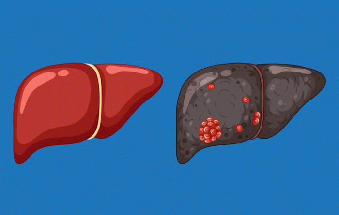سرطان کبد