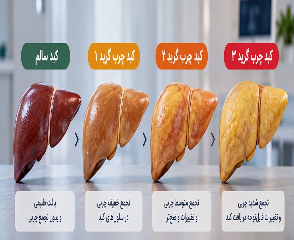 درمان کبد چرب گرید 1 تا 3
