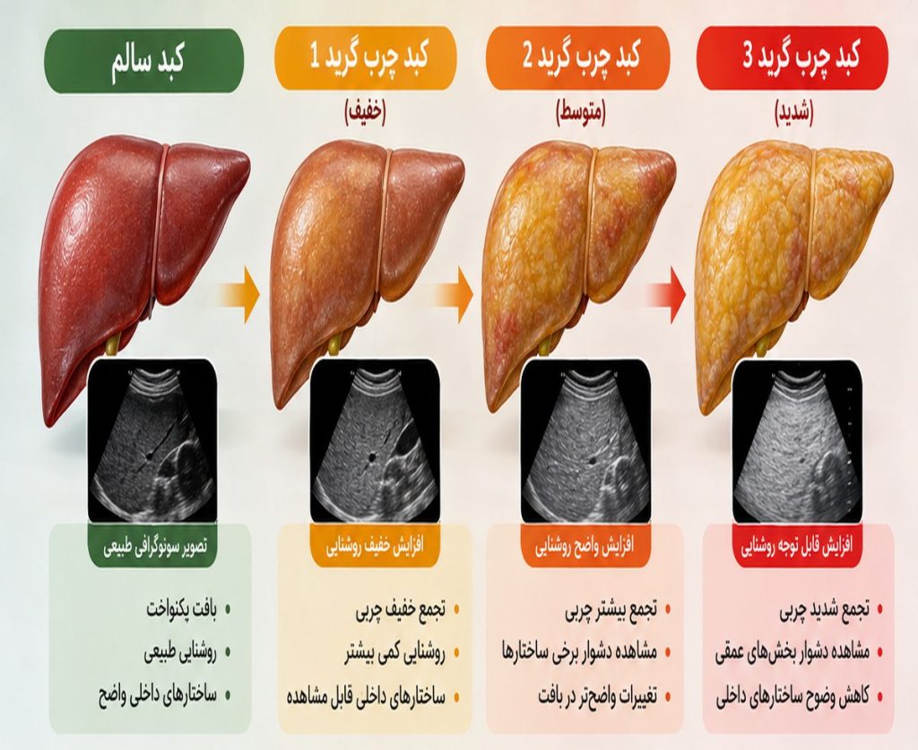کبد چرب گرید ۱، ۲ و ۳